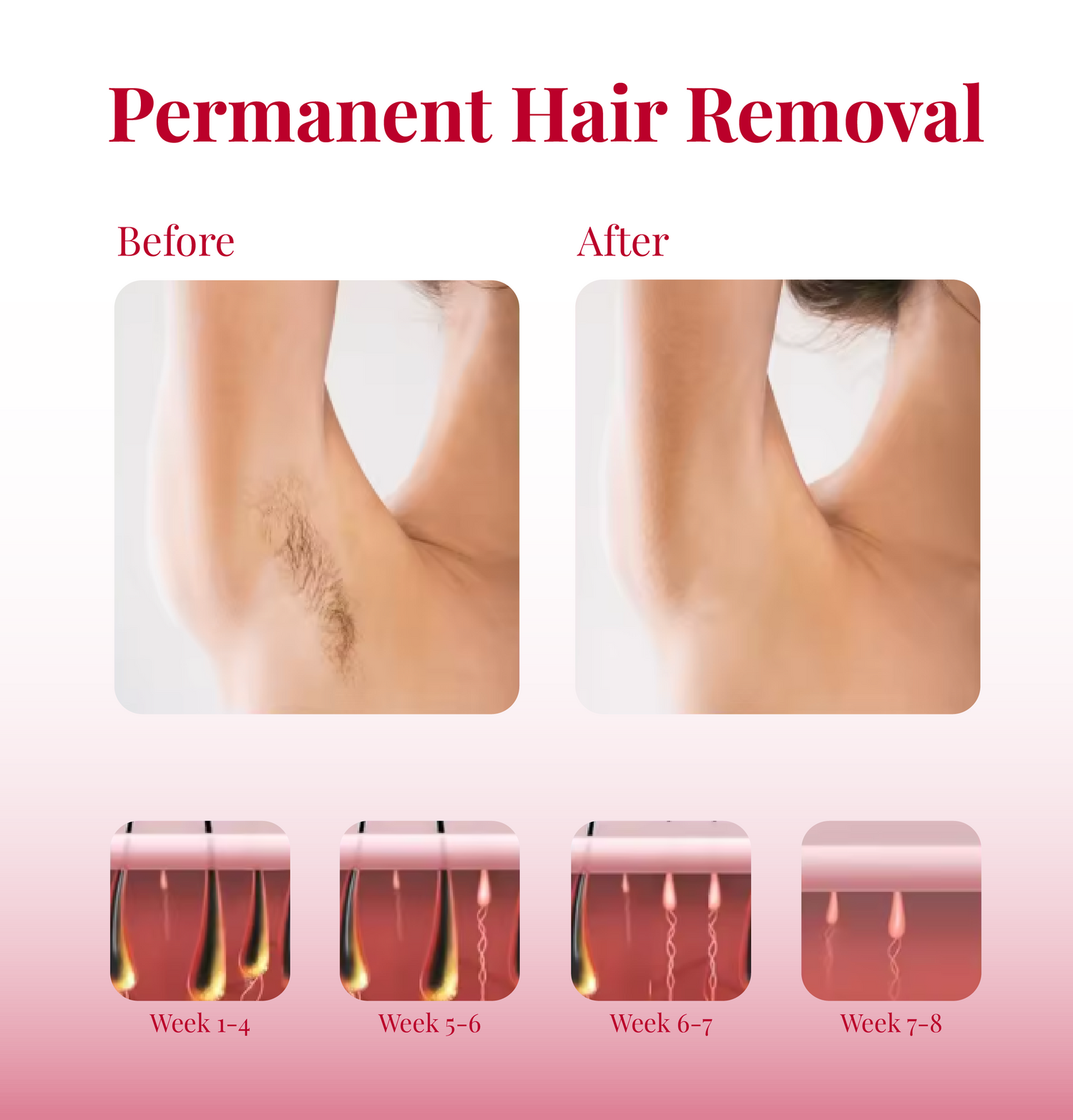 Before and after comparison of permanent hair removal with a close-up of hair follicles at different stages.